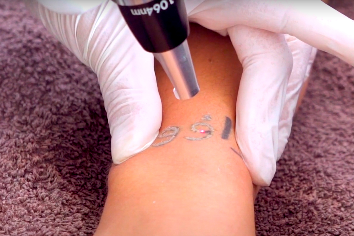 Cómo eliminar un tatuaje